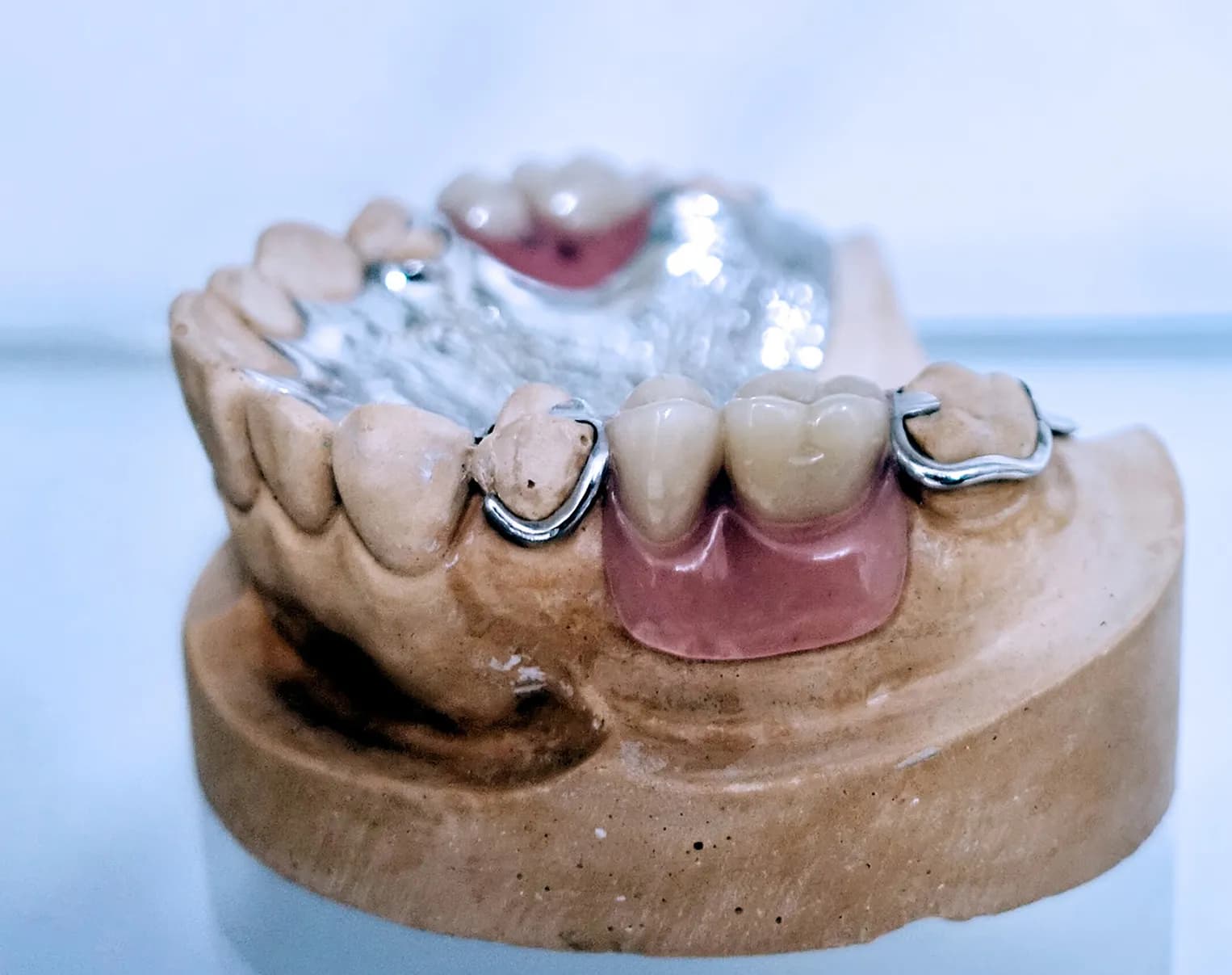 Cast-clasp partial denture shown on a dental model