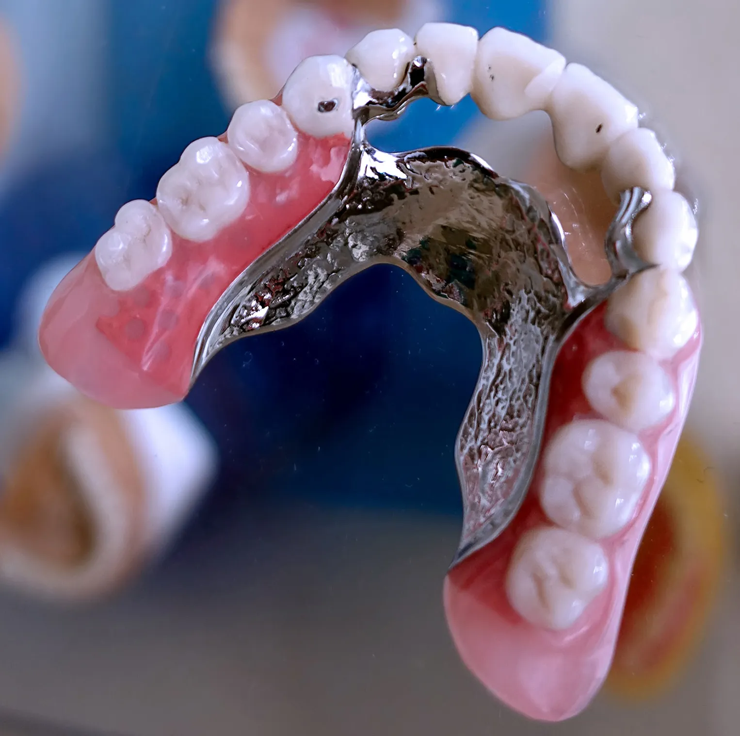 Close-up of a combined cast-clasp partial denture