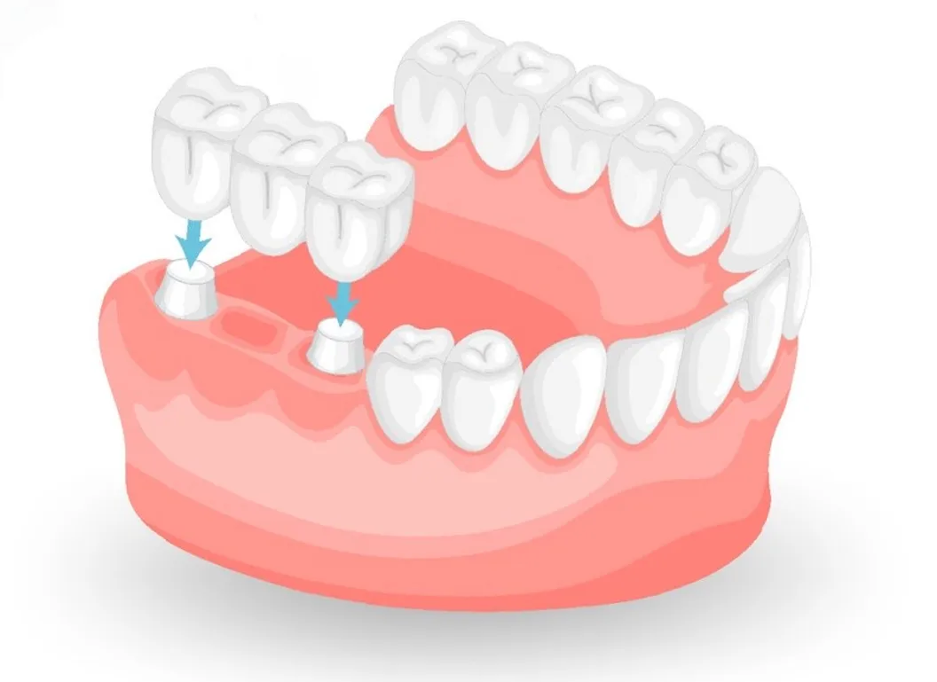 Illustration of a dental bridge replacing missing teeth