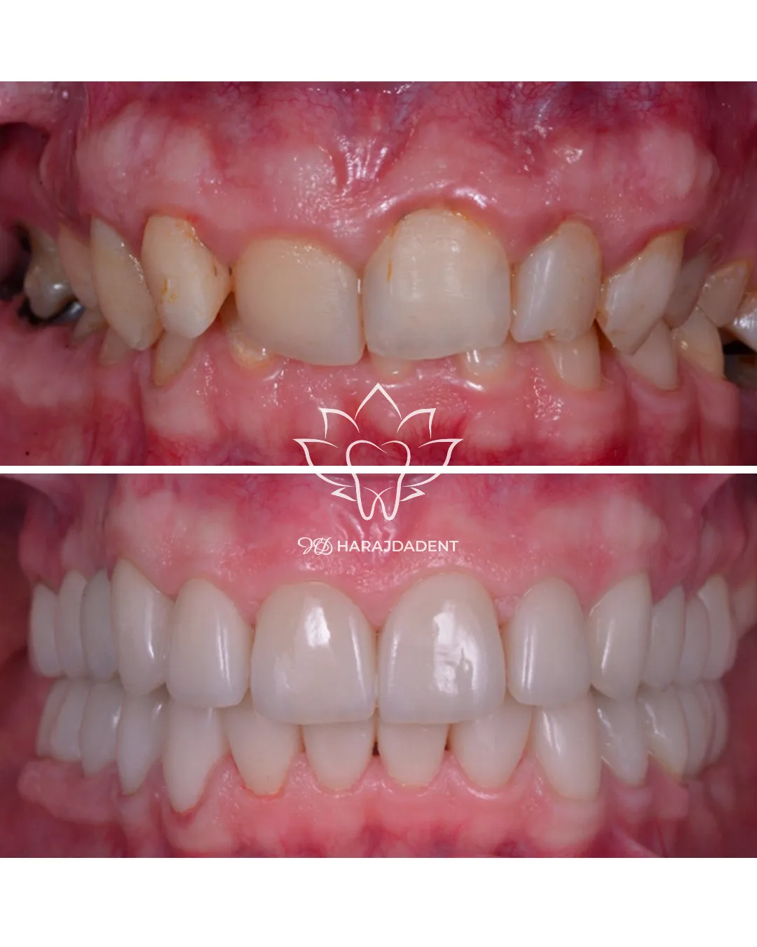 Before and after photo of a dental restoration case at Harajda Dent