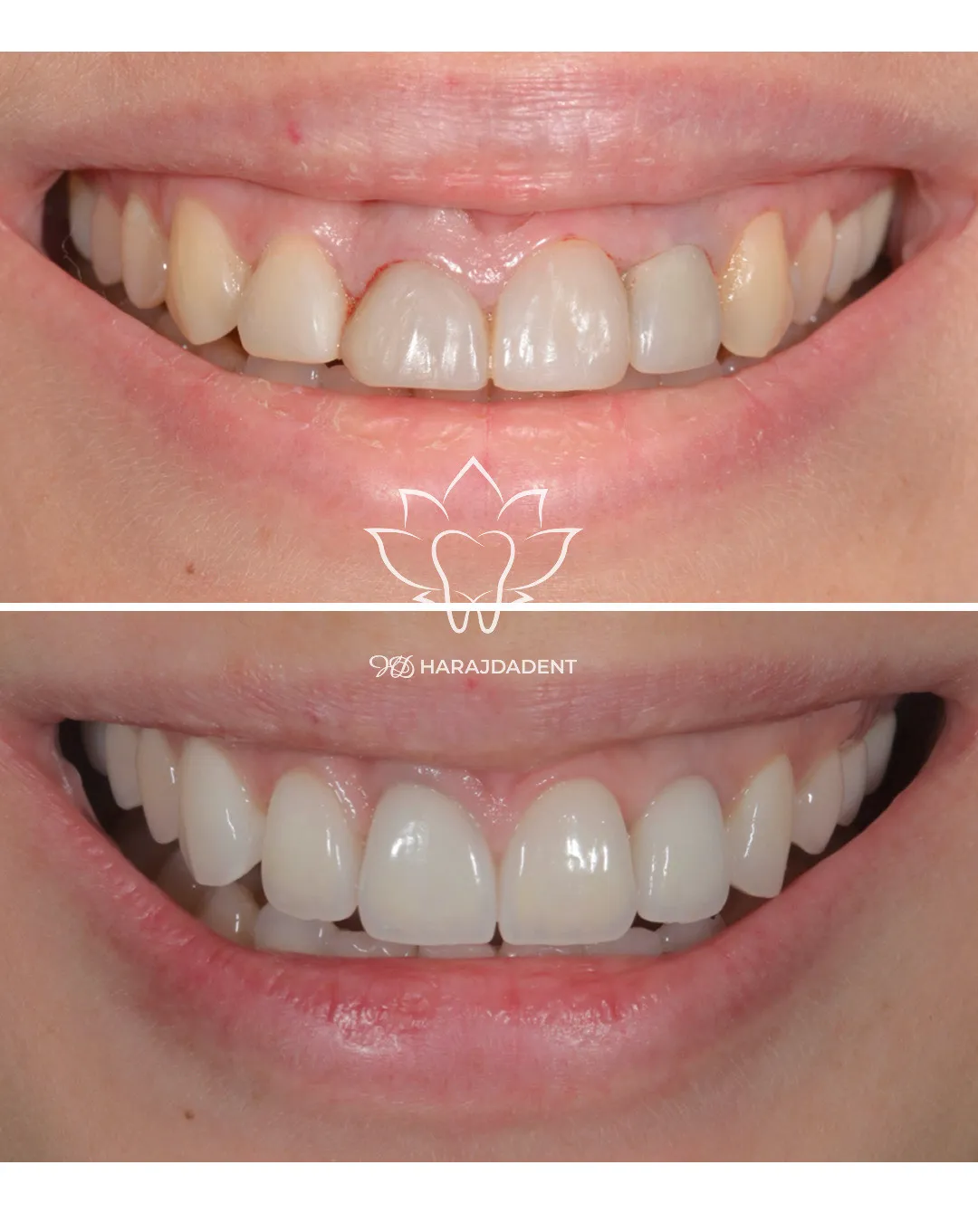 Before and after photo of a cosmetic dental treatment at Harajda Dent