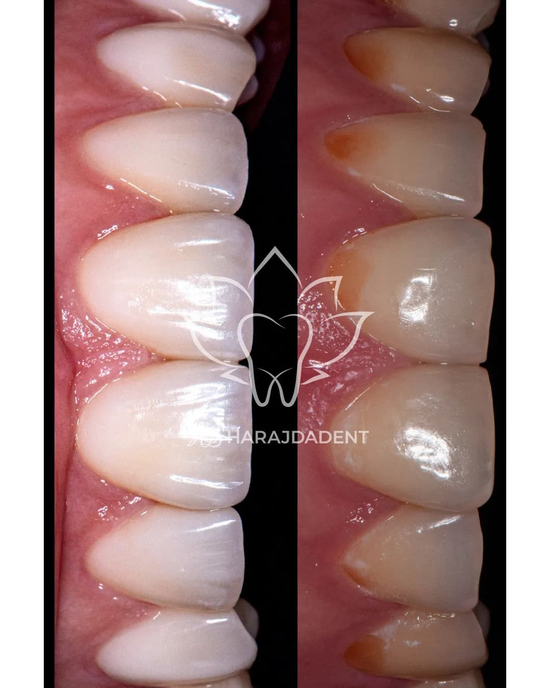 Before and after macro close-up of tooth restoration at Harajda Dent