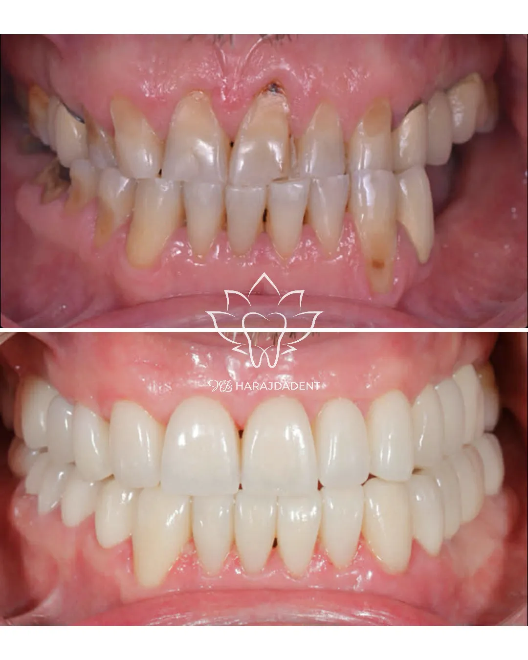 Before and after photo of a smile makeover with veneers at Harajda Dent