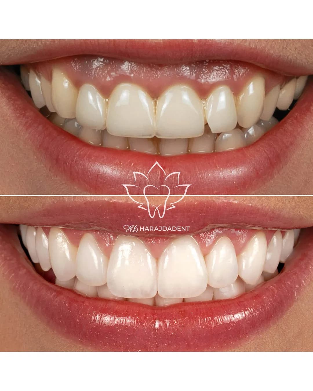 Before and after photo of a veneer smile makeover at Harajda Dent